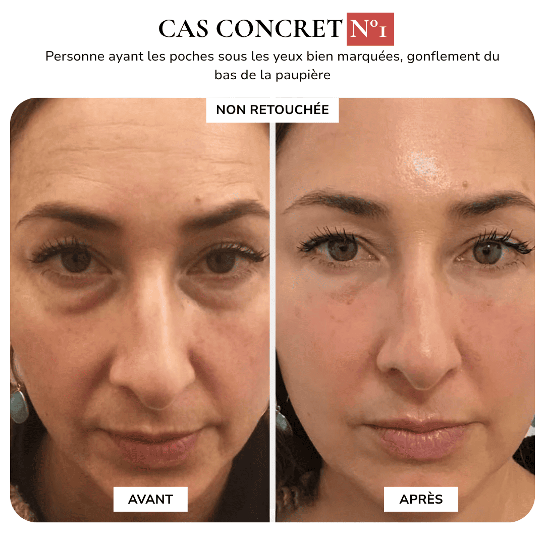 MAISON SAFIA™ : Patchs Yeux Anti-Cernes